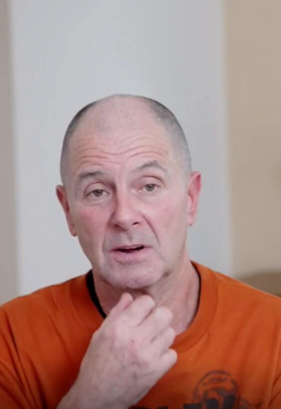 Ian - Dental Implants before after images