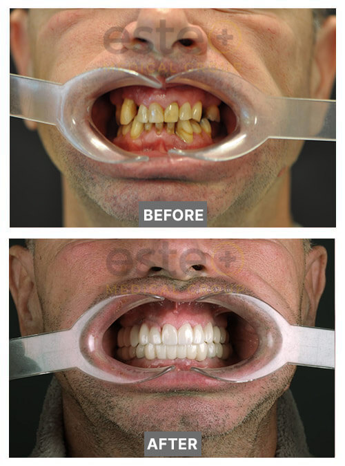 Ian - Dental Implants before after images