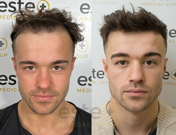 Mo Samuels's Hair Transplant before after images - Este
