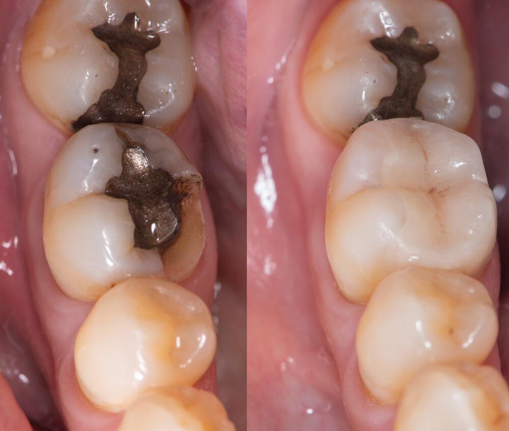 Inlays & Onlays before after image