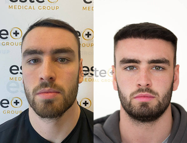 Hair Transplant before and after results