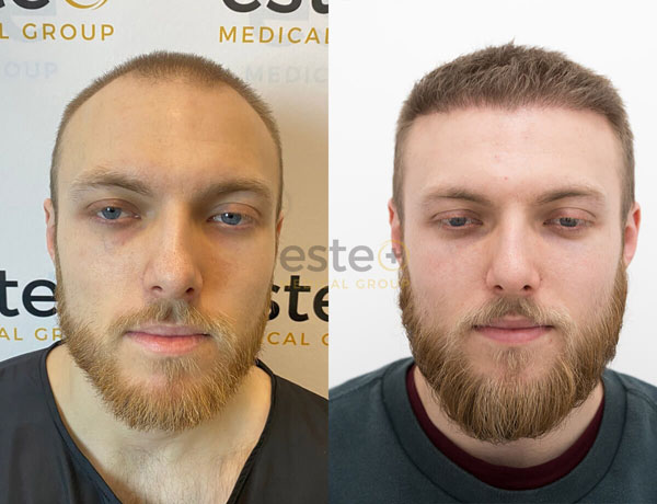 Hair Transplant before and after results