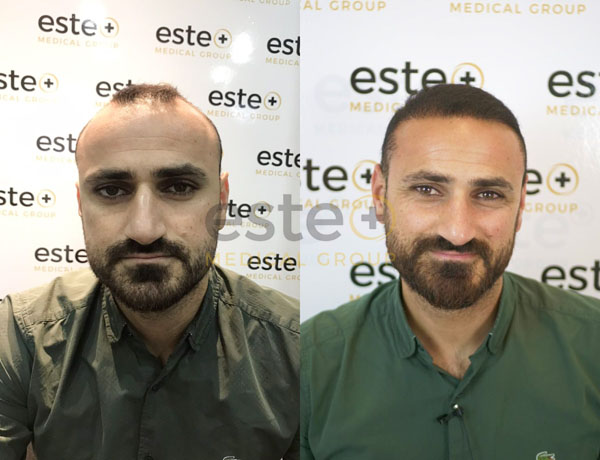 Hair Transplant before and after results