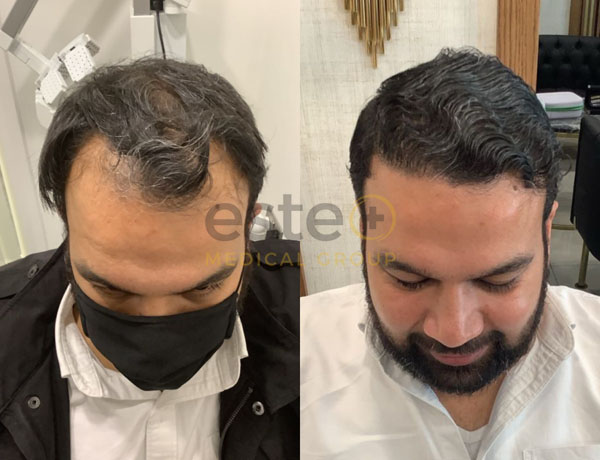 Hair Transplant before and after results