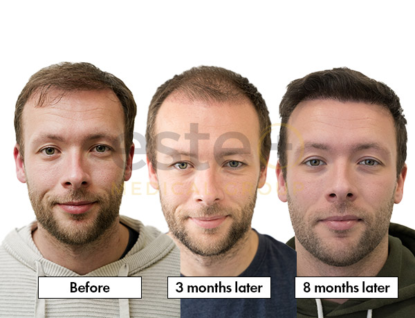 Hair Transplant Result