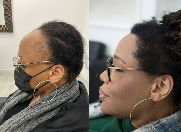 Before and After Result