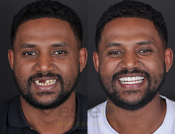 What makes FUE Hair Transplant Procedure the most Successful Technique?