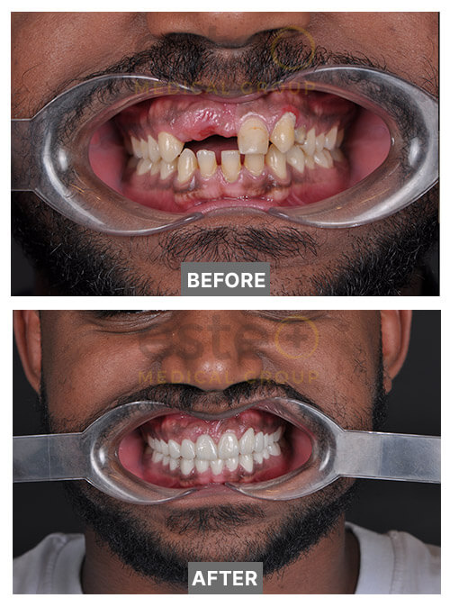 Samuel Dental missing tooth before after results 