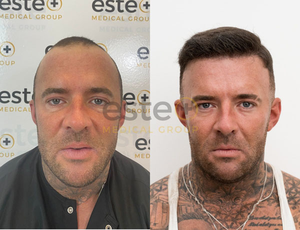 Before and after result