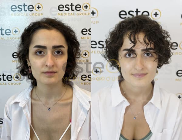 Curly hair transplant