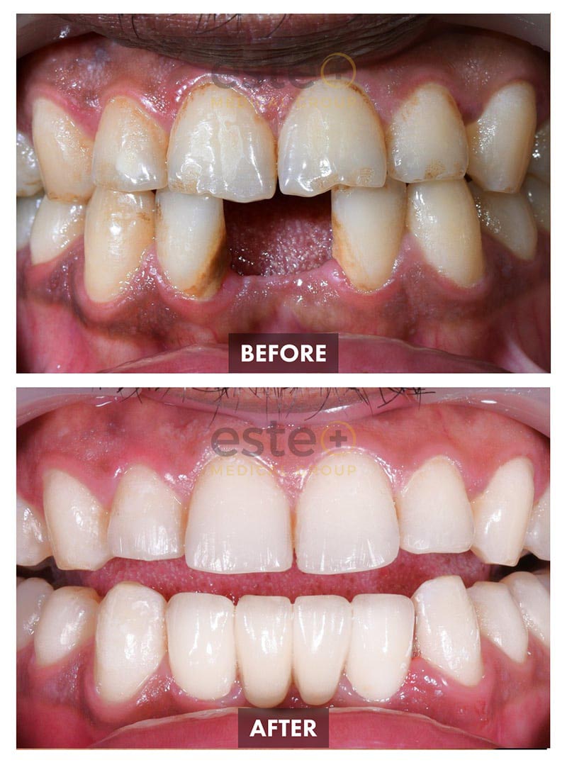 Dental Treatment before and after result