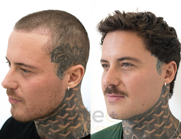 Hair transplant before and after Leeds