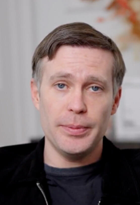 Dane Macaulay - Hair Transplant before after images - Este
