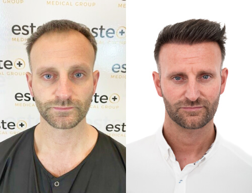 Dazz Hair Transplant before after images - Este