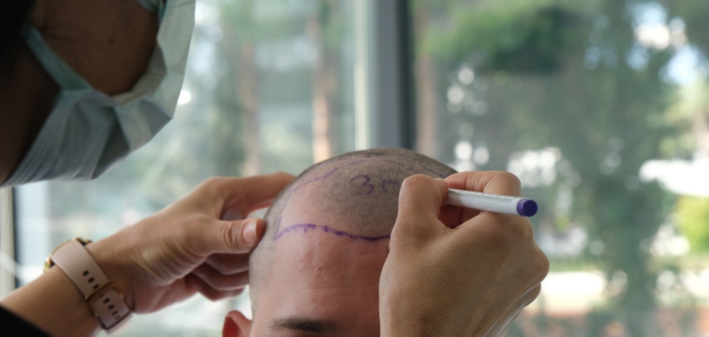 Hair Transplant in Turkey