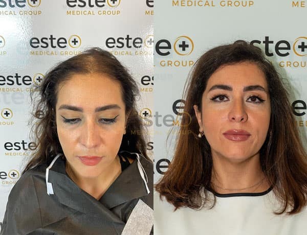 Hair loss treatment result