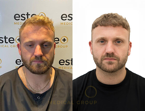 Steven - Hair transplant results with Este Medical