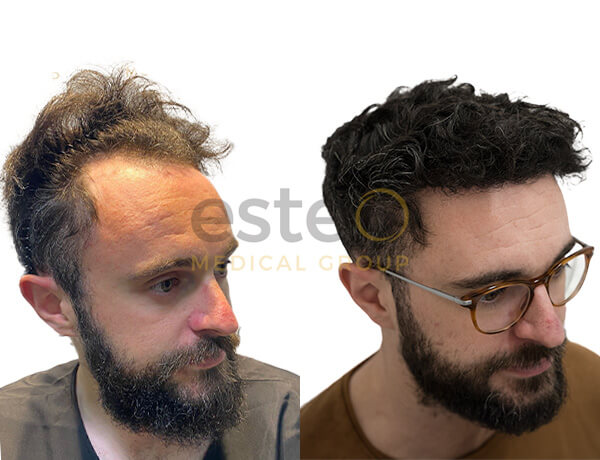 Hair transplant Turkey before and after
