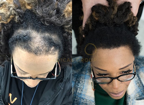 female hair transplant before and after