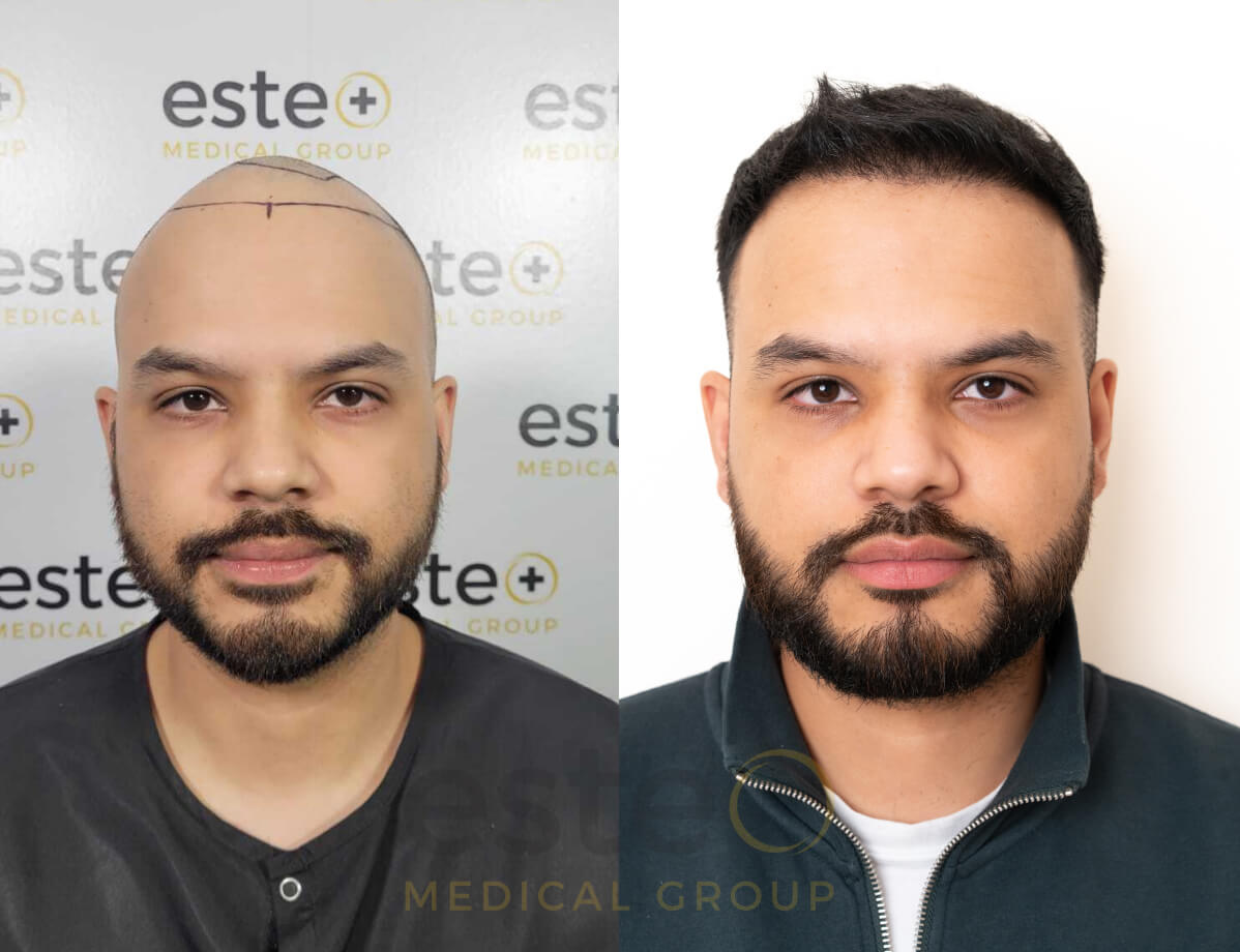 Hair transplant before and after Leeds