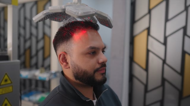Anil's Hair Transplant Story 5 Months on - Este Medical
