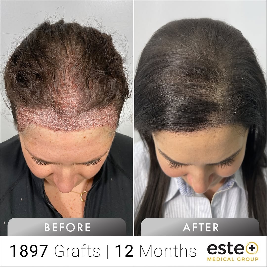 DHI hair transplant female