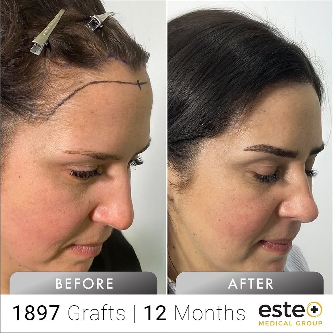  Female hair transplant results