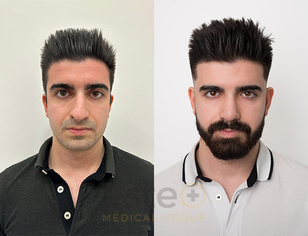 Nose job before-after results with Este Medical