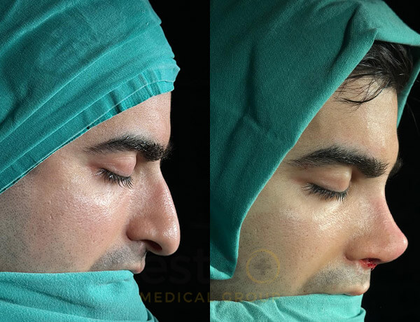 Nose job before-after results with Este Medical