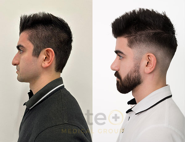 Nose job before-after results with Este Medical