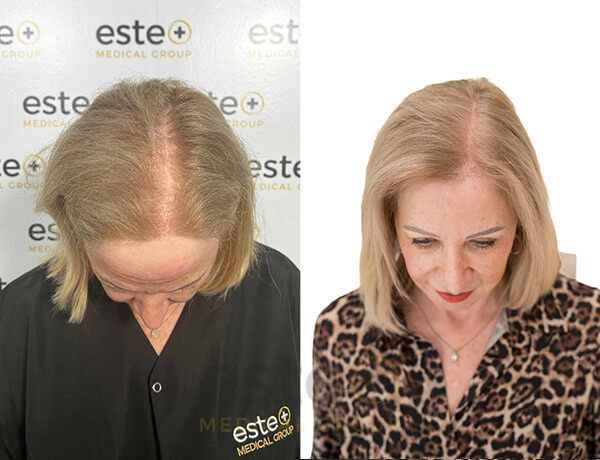 Hair transplant before and after Leeds