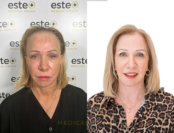 Gwyneth Macdonald - Hair Transplant with Este Medical