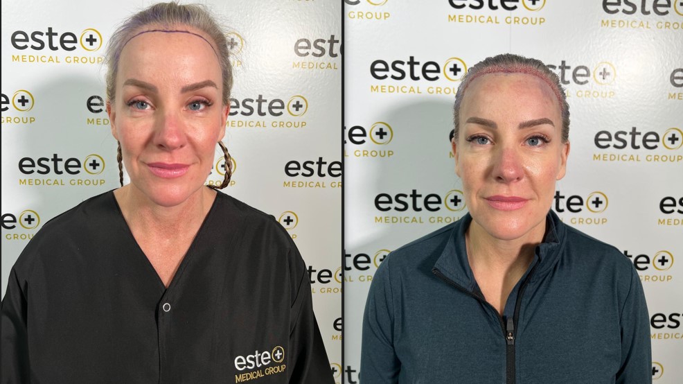 kelly before and after Unshaven hair transplantation treatment picture 