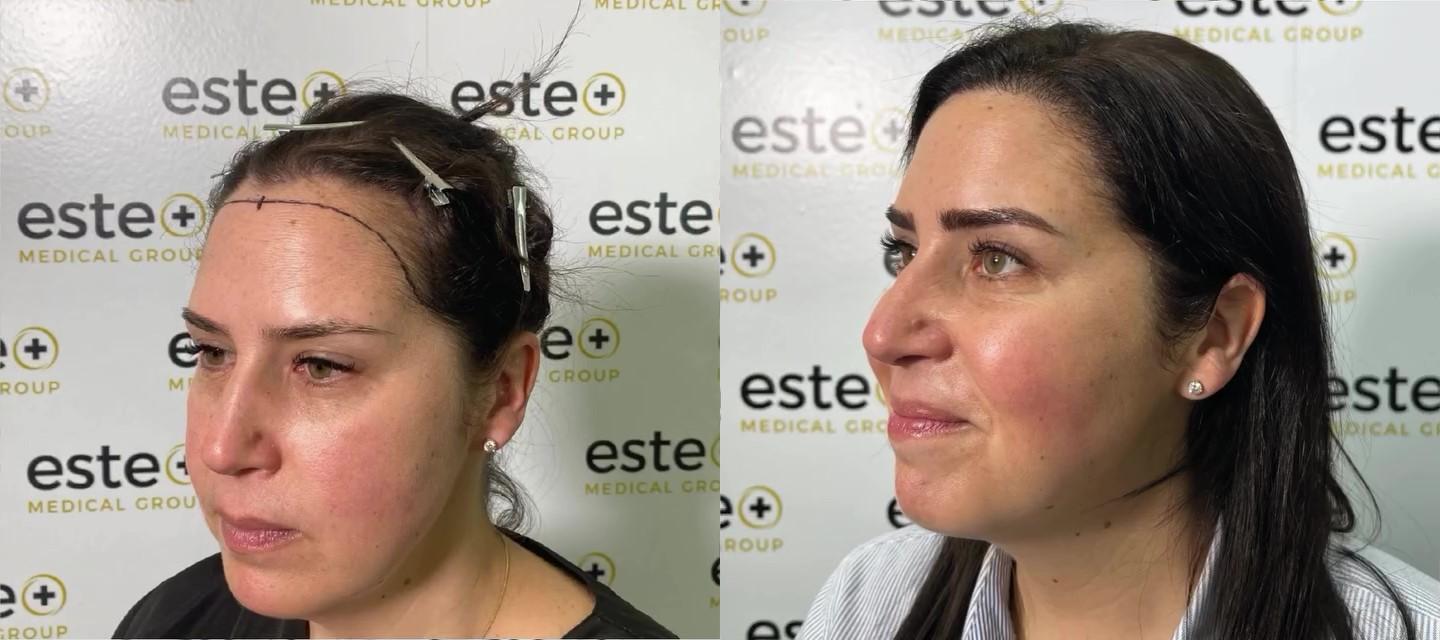 Hair transplant before and after result