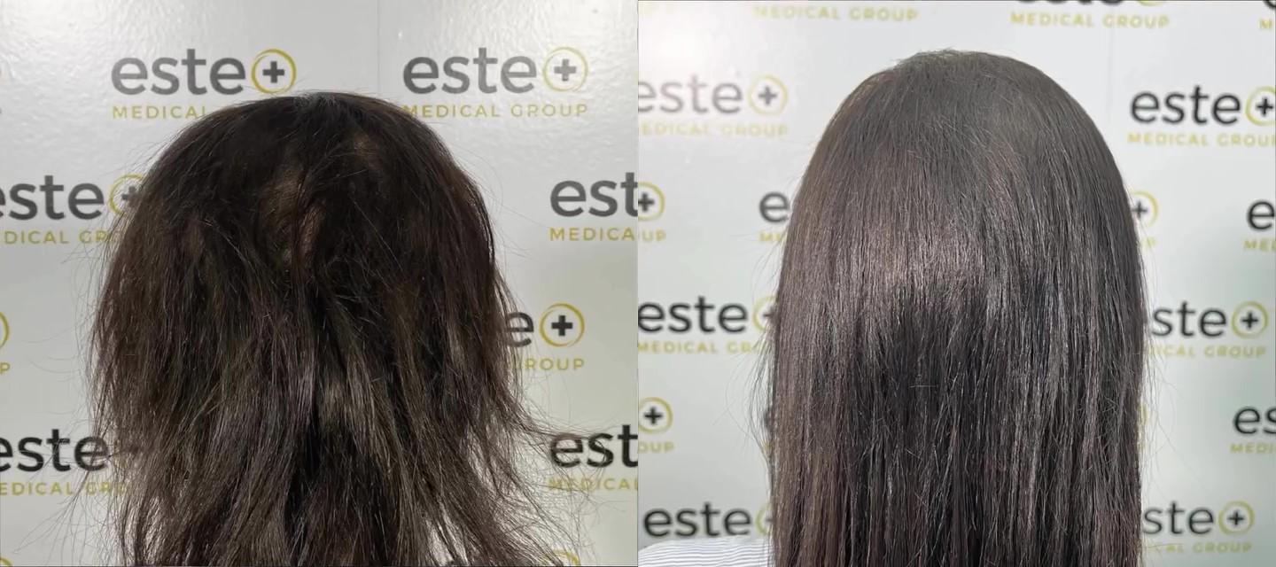 Before and after result with Sapphire FUE in Turkey