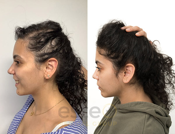 Rawan Hair Regrowth Results - Este Medical