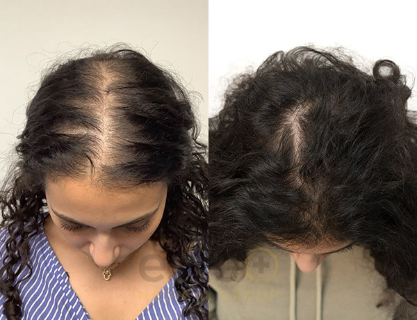 Rawan Hair Regrowth Results - Este Medical
