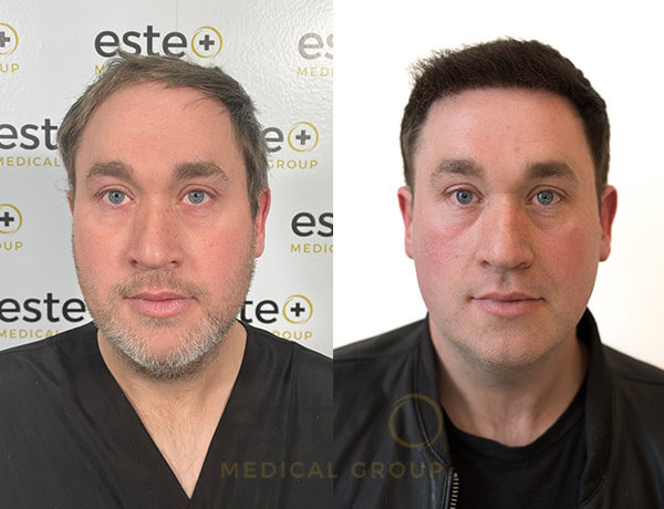 Hair transplant Men
