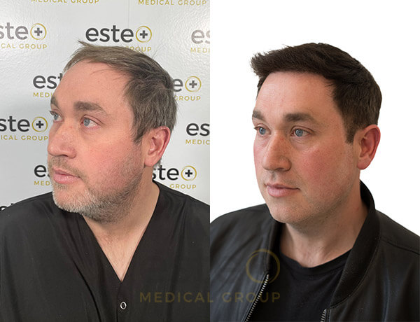 Hair transplant Men