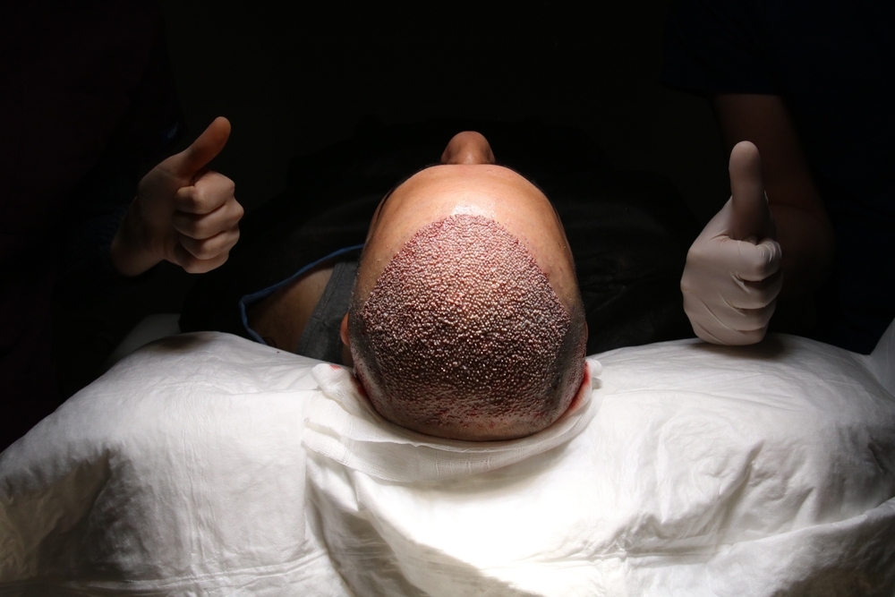  Bosley hair transplant cost