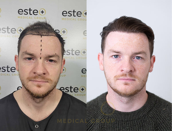 Hair transplant Men