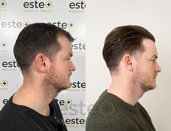Hair transplant Men