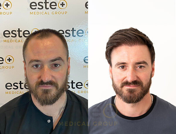 Hair transplant Men