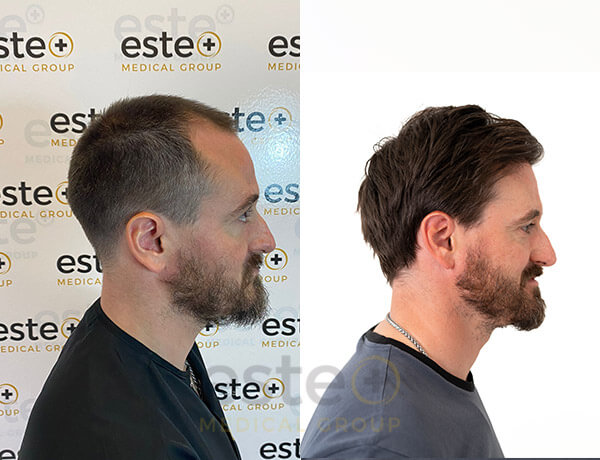Hair transplant Men