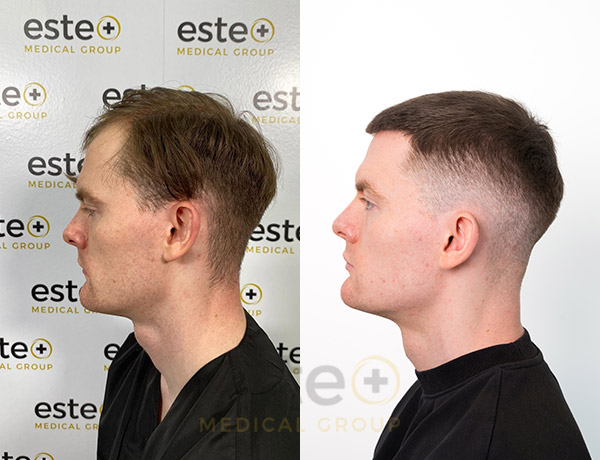 Hair transplant before and after Leeds