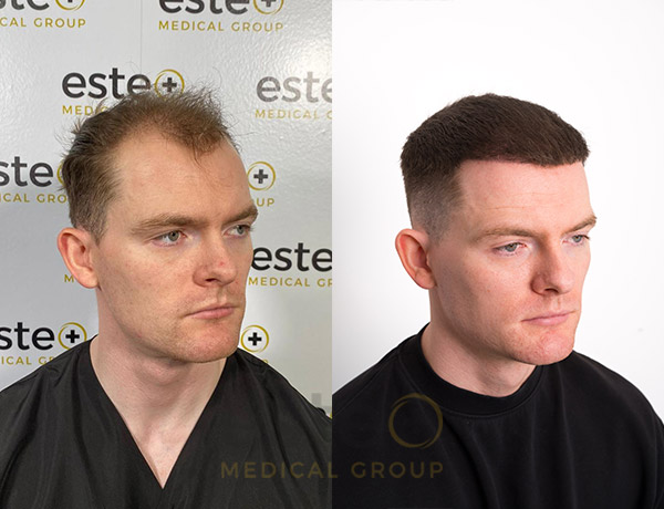 Turkey hair transplant before and after results