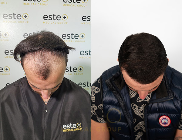 Hair transplant Men