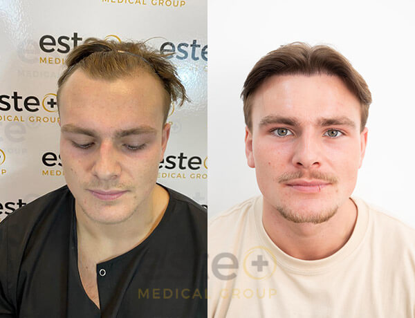 Daniel Mckenzie's hair transplant with Este Medical