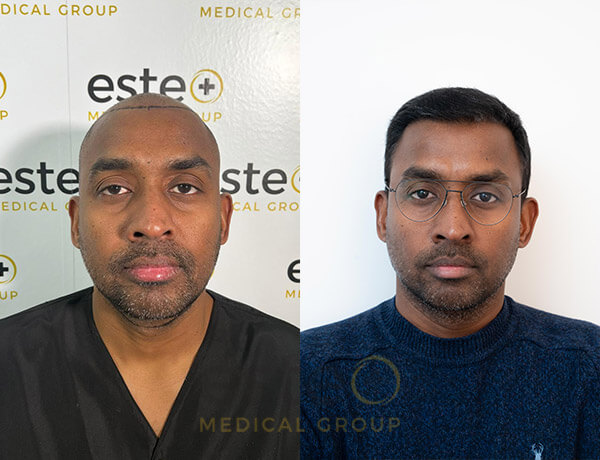 Mahesh hair transplant with Este Medical