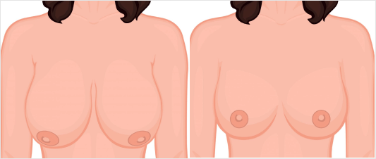 What makes FUE Hair Transplant Procedure the most Successful Technique?